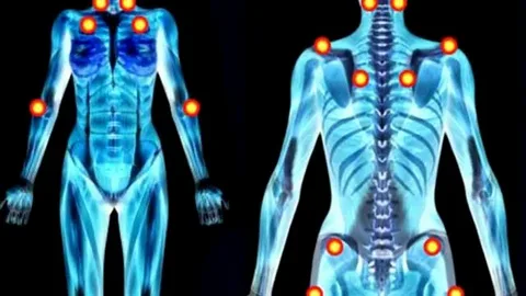 fibromialgia